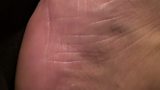 Bed sores